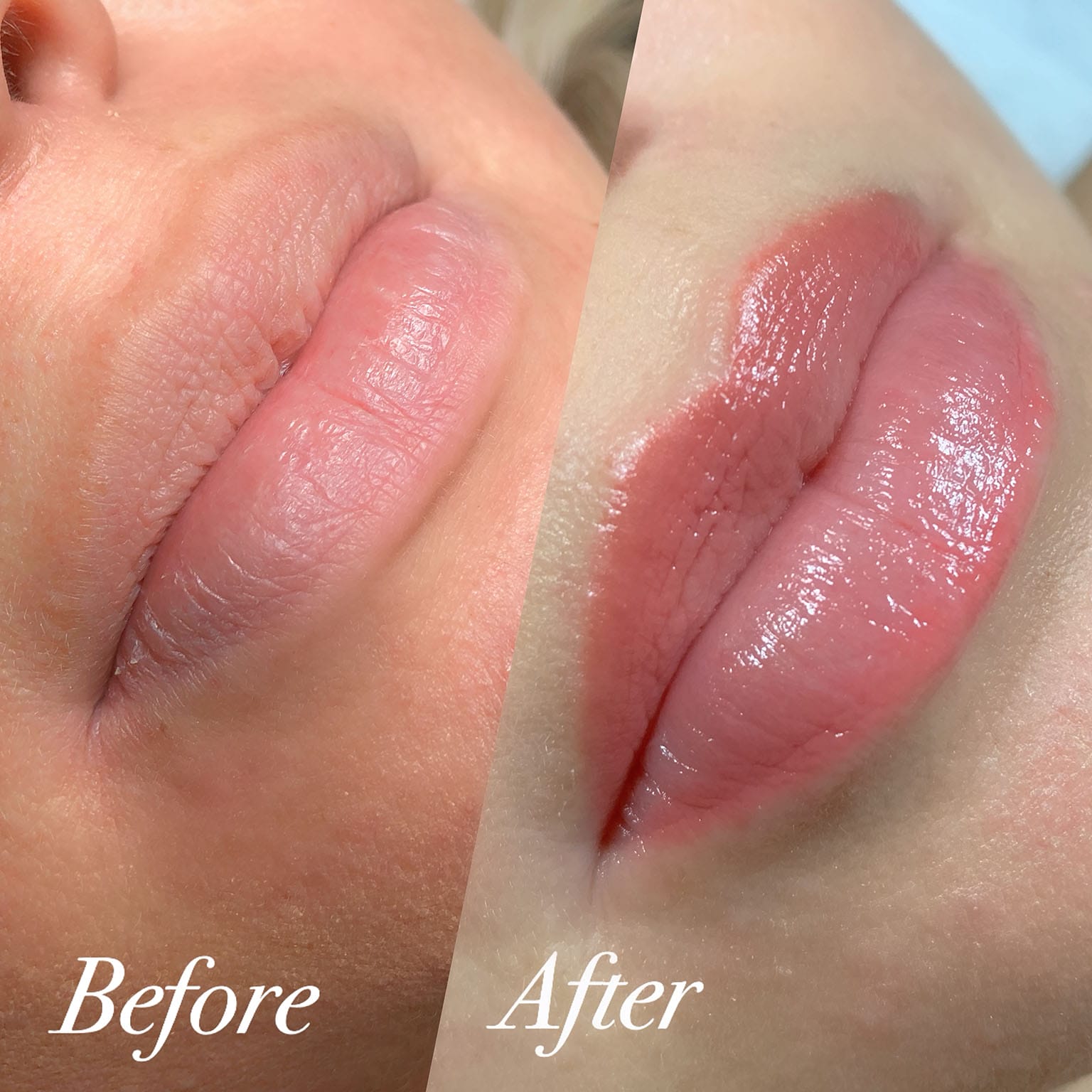 Experience the transformative services at YOLOve Beauty in Dartmouth, NS. Our side-by-side comparison showcases the stunning results of our lip enhancement procedures. On the