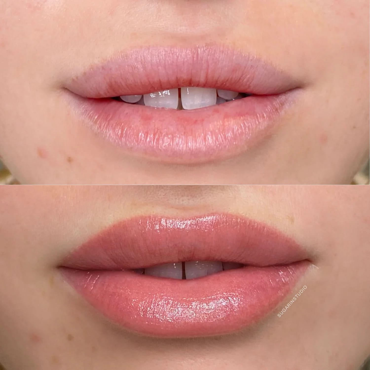 Discover the transformative services at YOLOve Beauty in Dartmouth, NS. The top image highlights natural lips with a slight gap between the teeth, while the bottom showcases beautifully enhanced, fuller lips with a glossy finish and no visible gap. Both images offer a close-up view of our exceptional lip treatments.